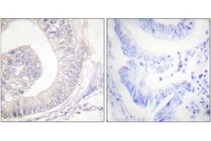 Immunohistochemistry analysis of paraffin-embedded human colon carcinoma, using HSL (Phospho-Ser855/554) Antibody.