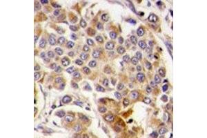 IHC analysis of FFPE human breast carcinoma tissue stained with AMPK antibody