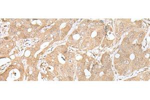 Immunohistochemistry of paraffin-embedded Human gastric cancer tissue using SMARCA1 Polyclonal Antibody at dilution of 1:30(x200)