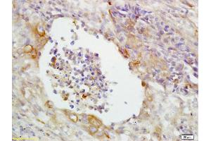 Formalin-fixed and paraffin embedded human lung carcinoma labeled with Anti-CD14 Polyclonal Antibody, Unconjugated (ABIN673164) at 1:200 followed by conjugation to the secondary antibody and DAB staining