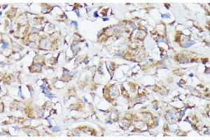 Immunohistochemistry of paraffin-embedded Human mammary cancer using MTHFD2 Polyclonal Antibody at dilution of 1:100 (40x lens).