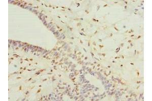 Immunohistochemistry of paraffin-embedded human breast cancer using ABIN7164641 at dilution of 1:100