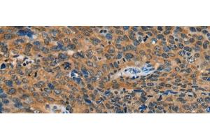 Immunohistochemistry of paraffin-embedded Human cervical cancer tissue using YTHDF1 Polyclonal Antibody at dilution of 1:55(x200)