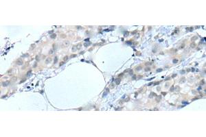 Immunohistochemistry of paraffin-embedded Human breast cancer tissue using MOG Polyclonal Antibody at dilution of 1:25(x200)