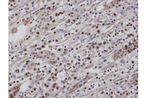 IHC-P Image Immunohistochemical analysis of paraffin-embedded human gastric cancer, using EAR2 , antibody at 1:100 dilution.