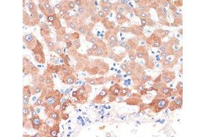 Immunohistochemistry of paraffin-embedded Human liver cancer using CHAT Polyclonal Antibody at dilution of 1:200 (40x lens).