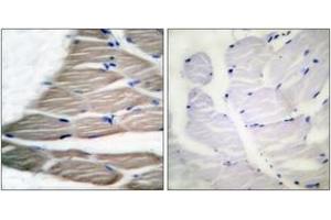 Immunohistochemistry analysis of paraffin-embedded human breast carcinoma, using ACC1 (Phospho-Ser80) Antibody.