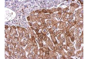 IHC-P Image PLGF antibody detects PGF protein at cytosol on human hepatoma by immunohistochemical analysis.