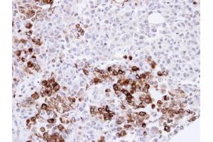 IHC-P Image Immunohistochemical analysis of paraffin-embedded H1299 xenograft, using Gelsolin, antibody at 1:500 dilution.