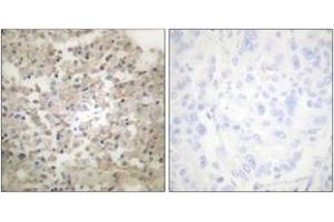 Immunohistochemistry analysis of paraffin-embedded human lung carcinoma, using Tryptophan Hydroxylase (Phospho-Ser260) Antibody.