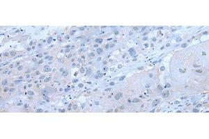 Immunohistochemistry of paraffin-embedded Human esophagus cancer tissue using XRN1 Polyclonal Antibody at dilution of 1:25(x200)