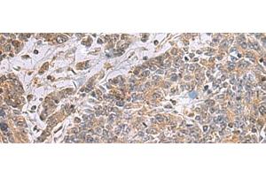 Immunohistochemistry of paraffin-embedded Human colorectal cancer tissue using UBTD1 Polyclonal Antibody at dilution of 1:25(x200)