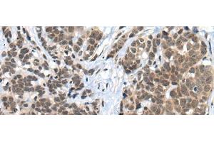 Immunohistochemistry of paraffin-embedded Human thyroid cancer tissue using ZNF83 Polyclonal Antibody at dilution of 1:50(x200)