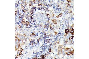Immunohistochemistry of paraffin-embedded Human lung adenocarcinoma using Siglec-15 Rabbit mAb (ABIN7270293) at dilution of 1:100 (40x lens).